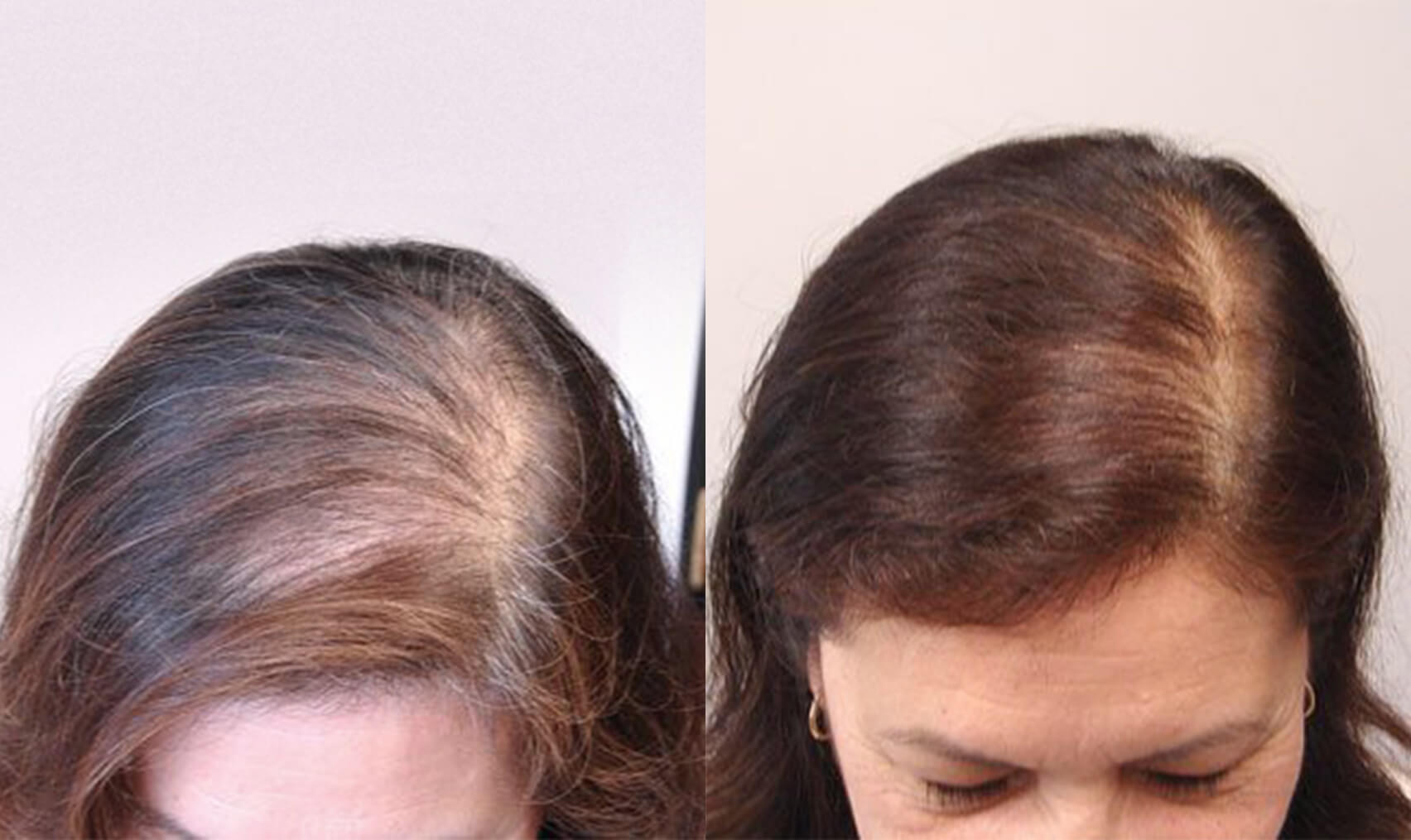 Female Hair Loss01
