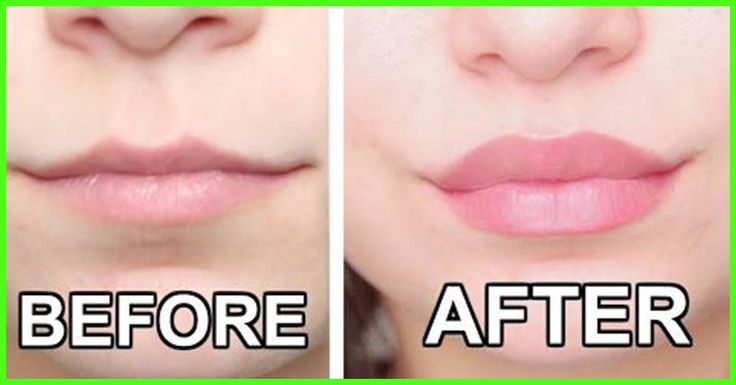 Derol Lip Plumper before and after
