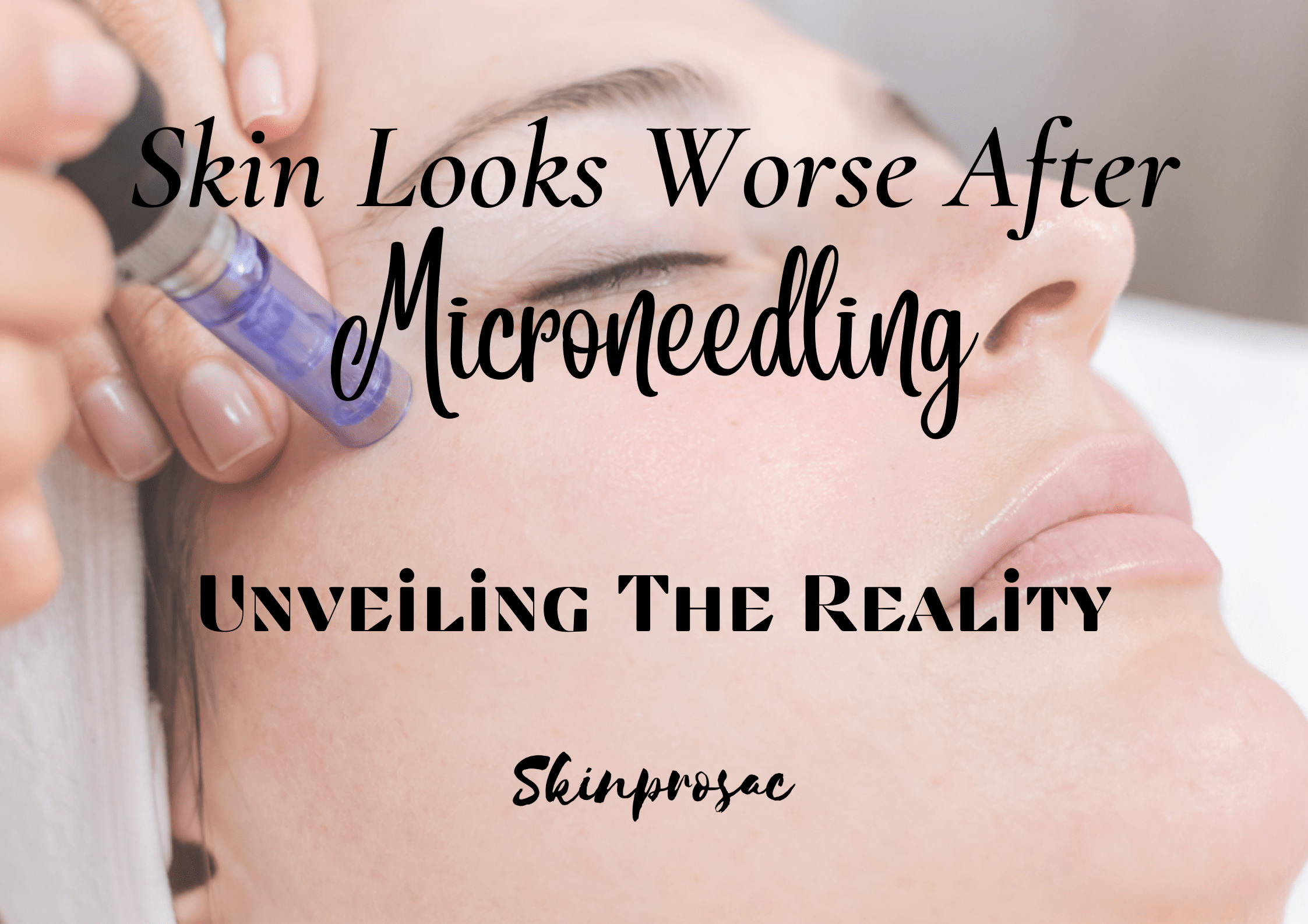 Skin Looks Worse After Microneedling