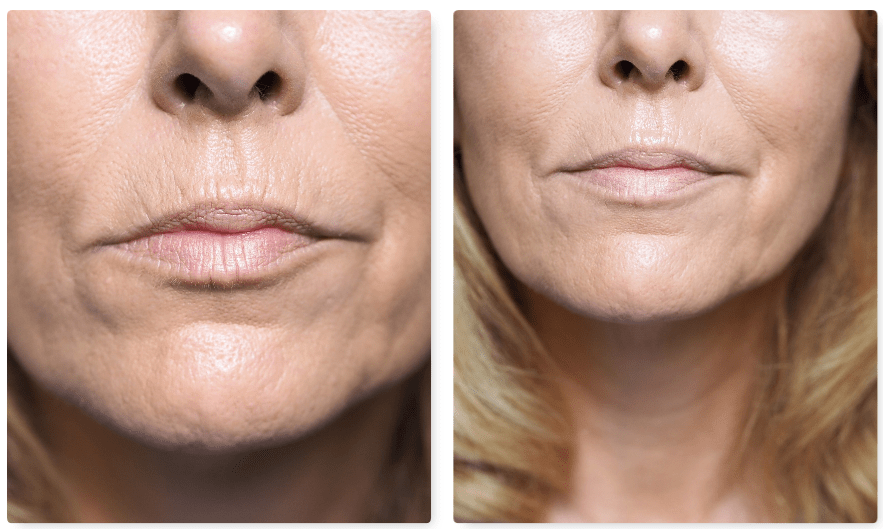 Jawline Uplift Serum before and after