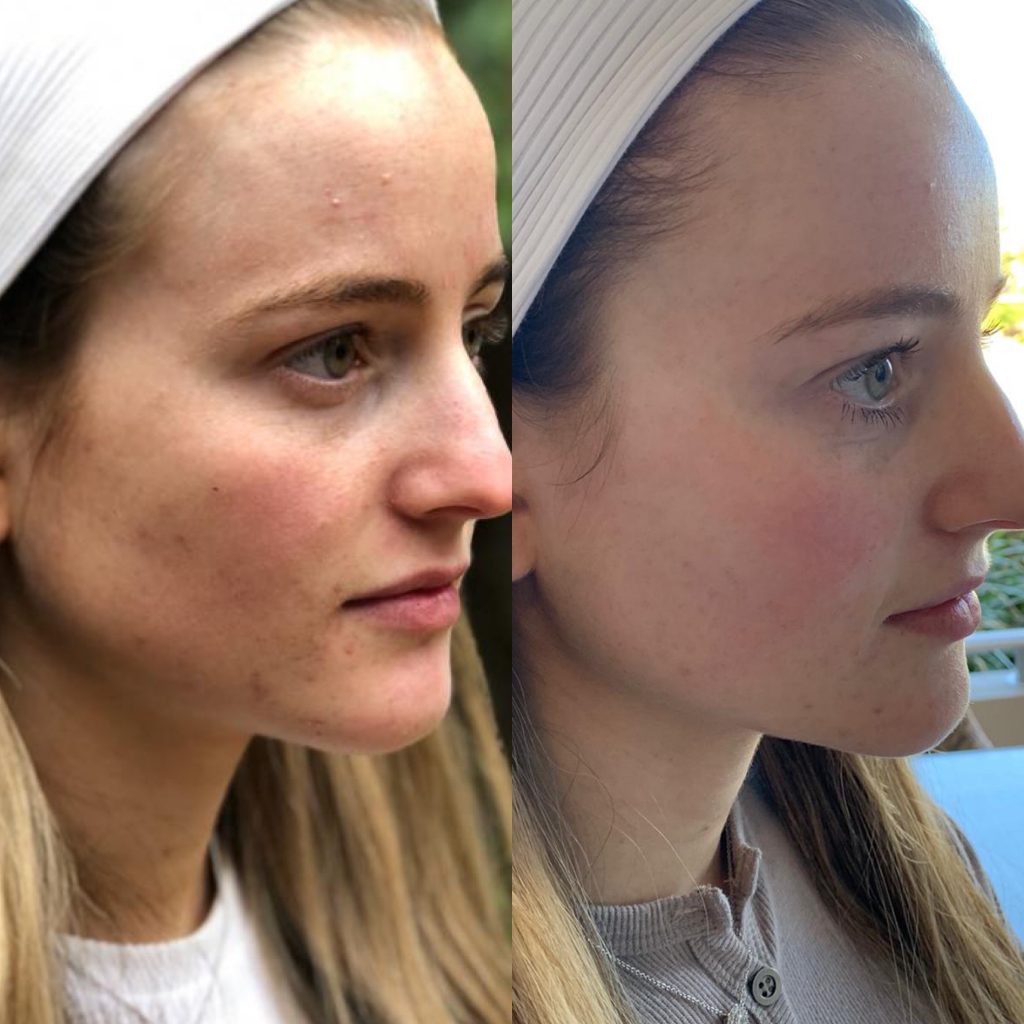 Lumiere Skin Serum before and after