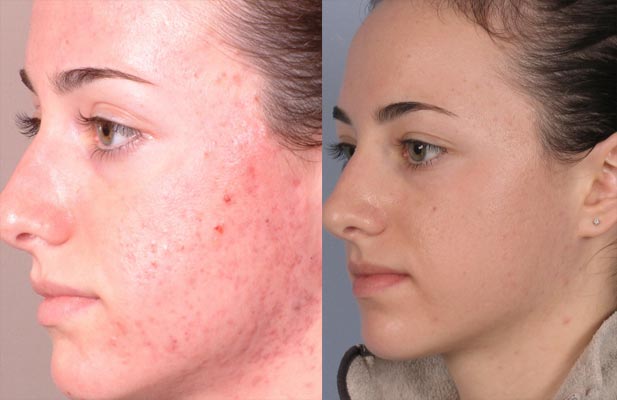 Misumi Skincare AHA 10% Skin Perfecting Cleanser before and after