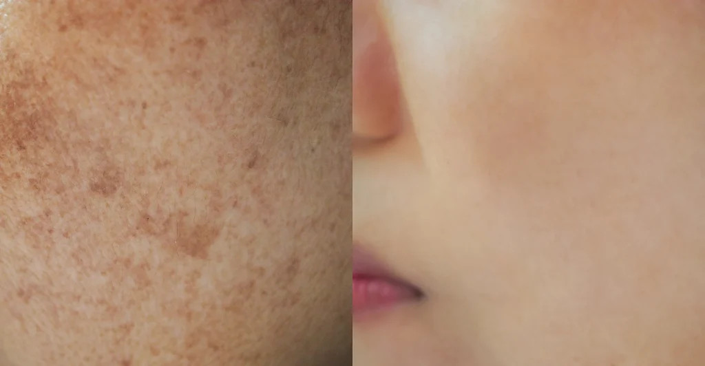 Naturium Multi-Bright Tranexamic Acid Treatment 5% before and after