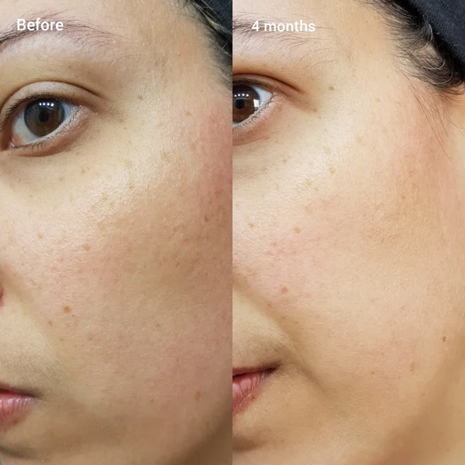 The Ordinary Retinol 1% in Squalane before and after