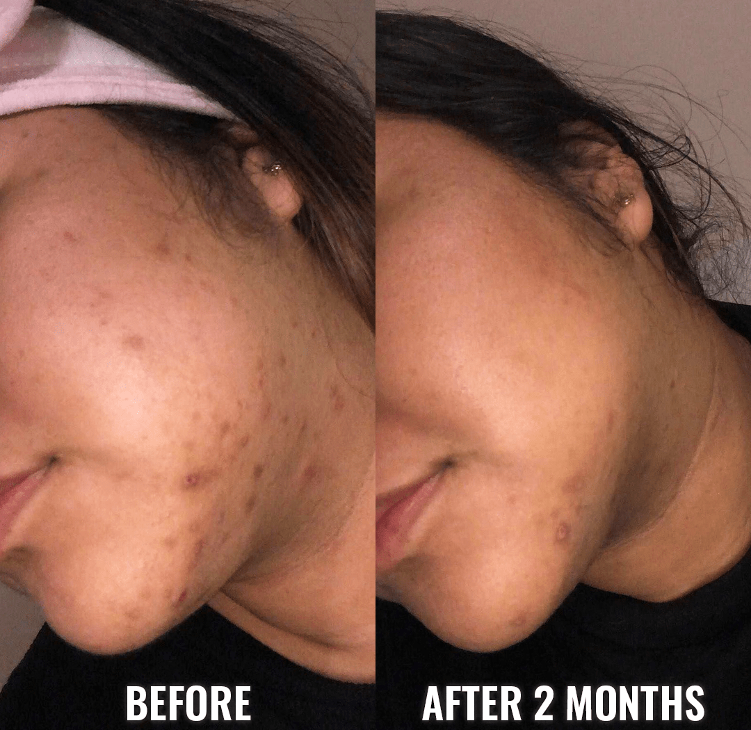 Good Molecules Discoloration Correcting before and after