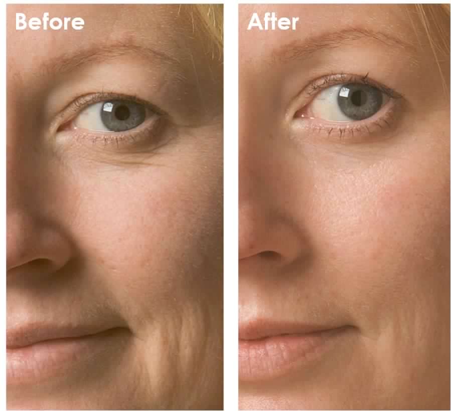 Clinical Results 24|7 Instant Firming Facial 3D Line Smoother before and after