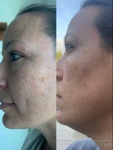 Organic Skin Spot Purifying Serum Before And After