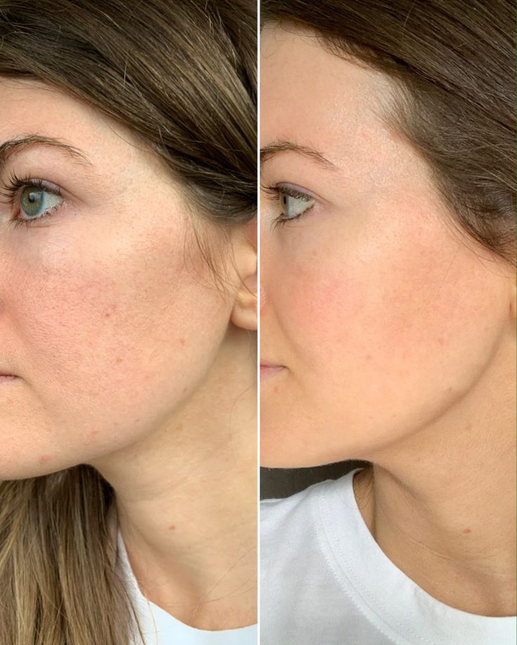 Peter Thomas Roth Retinol before and after