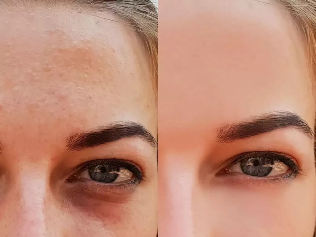 Seamantika Puffy Eyes Treatment Instant results before and after