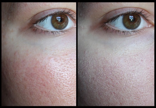 Clinique Redness Solutions before and after