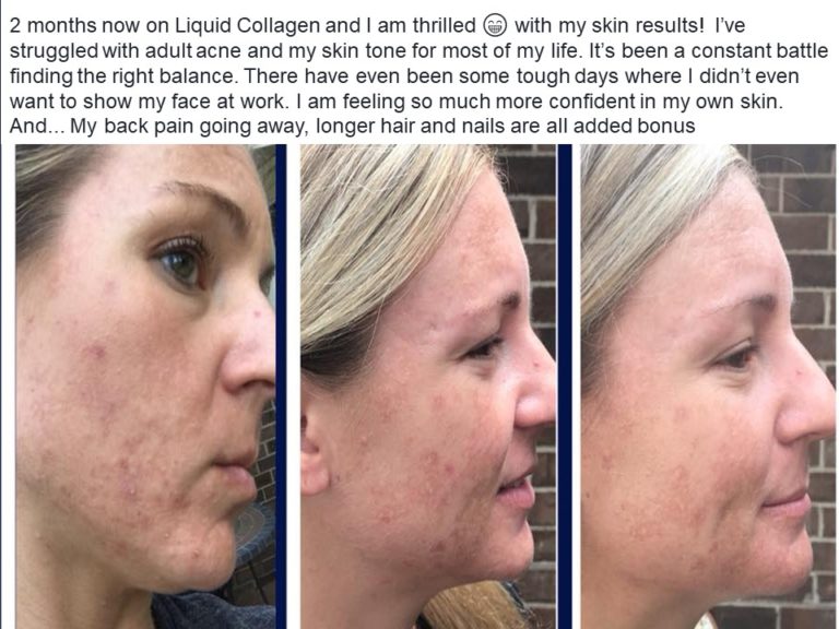 Biocell Liquid Collagen before and after
