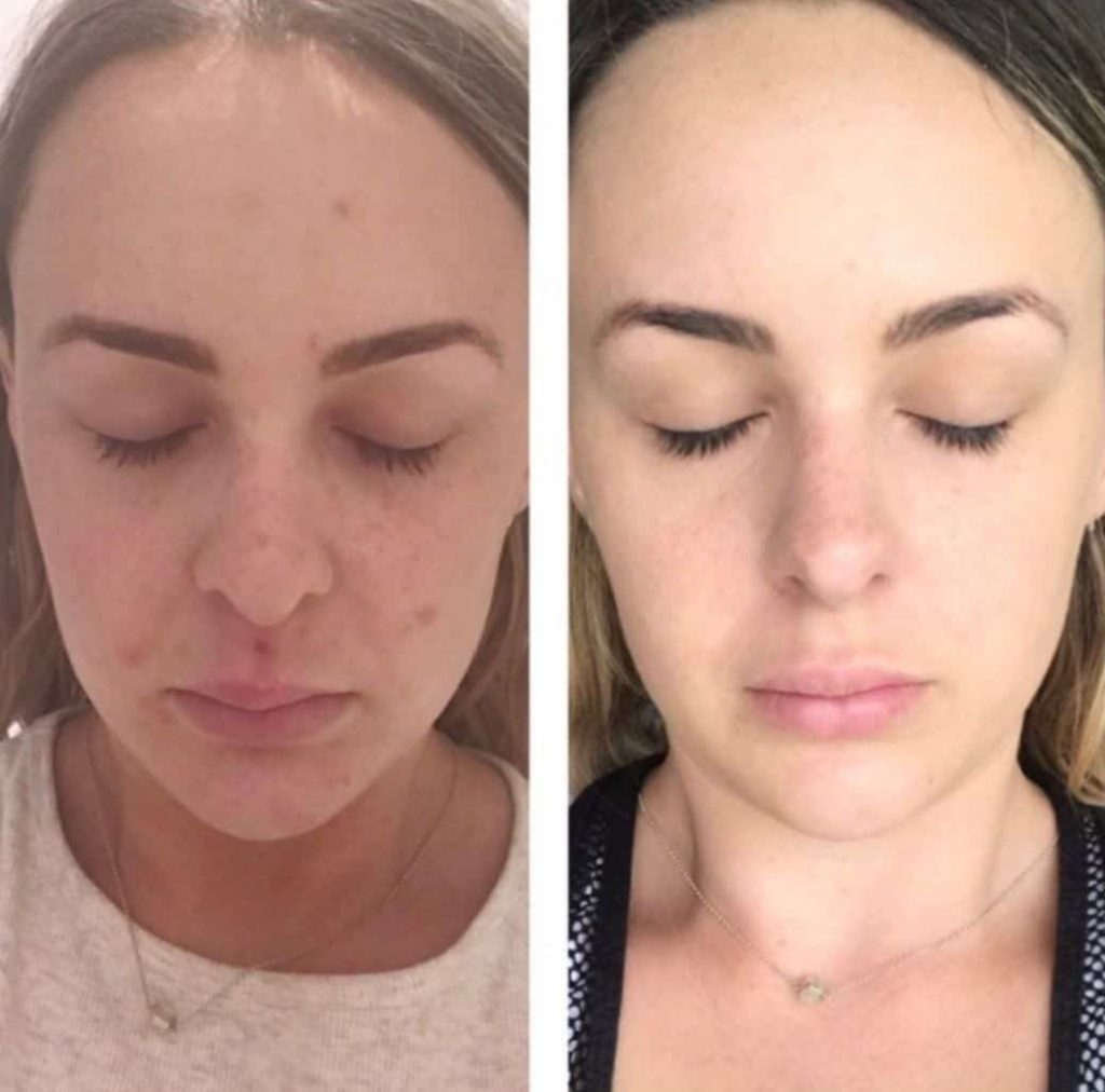 Prima Bella Skin Serum Before and After