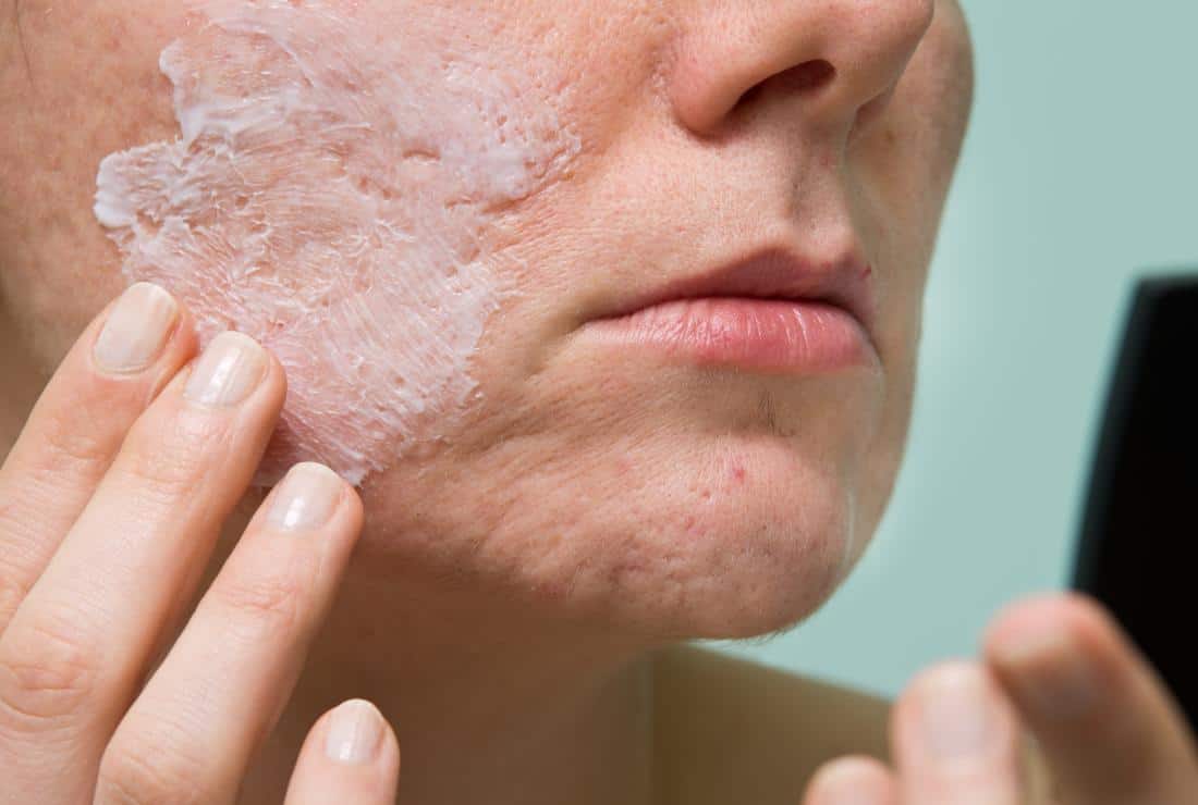 a woman treating acne and wondering the differences between salicylic acid vs benzoyl peroxide 1
