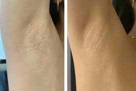 Dermabolt IPL Hair Removal before and after