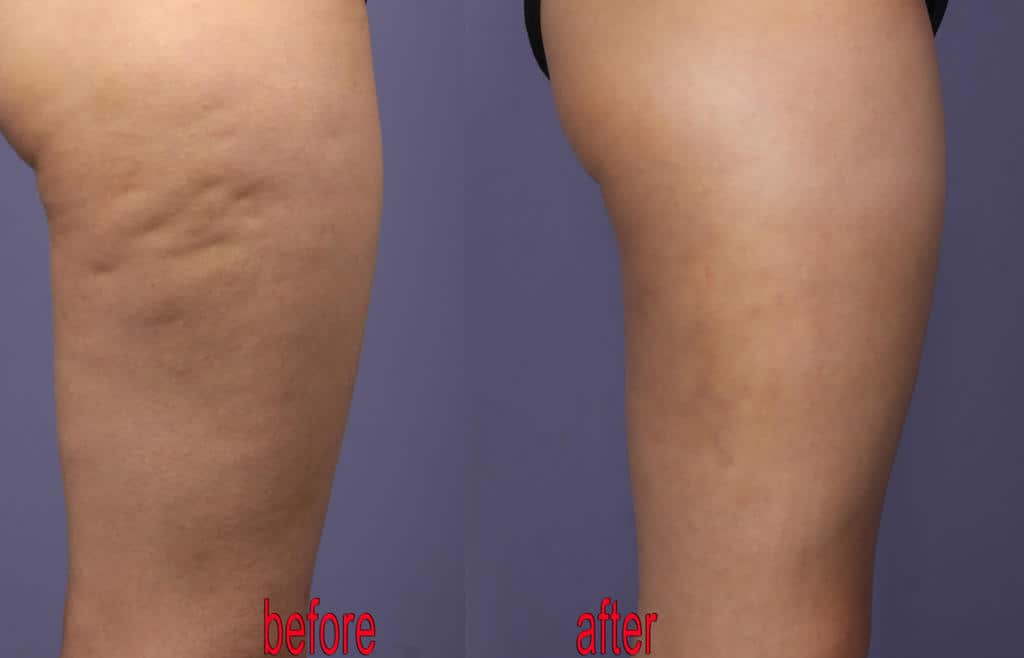 cellulite removed with photoshop by stefaniakzl da53bf7 fullview 1