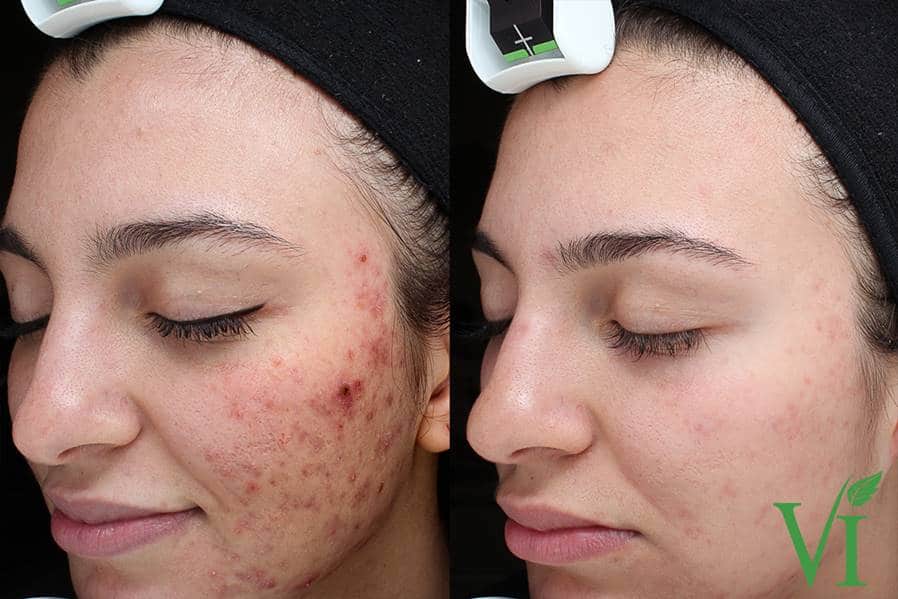 Acne and Acne Scarring 1