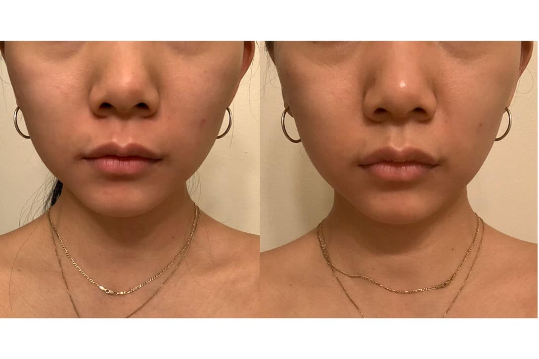Serious Skincare Reverse Lift Before And After