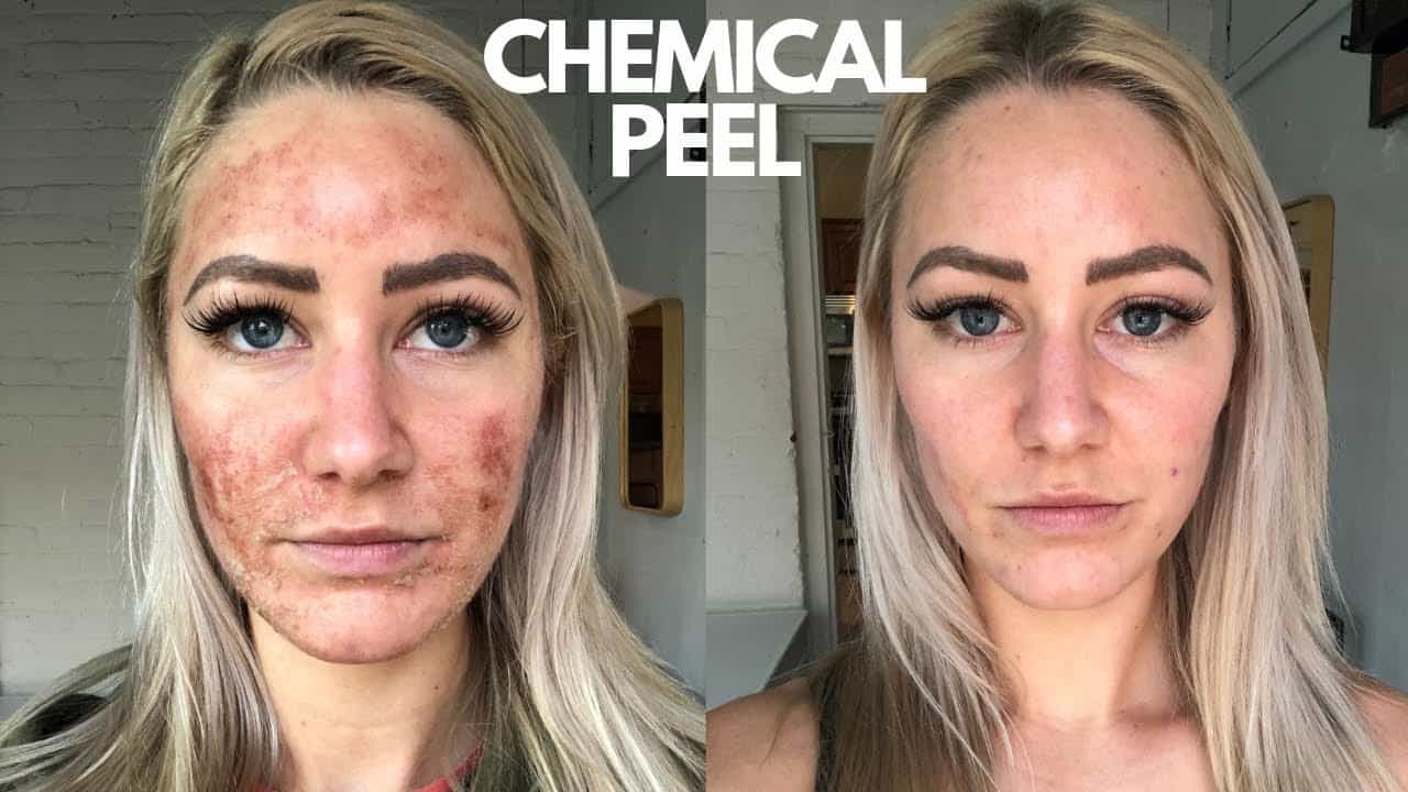 Can You Wear Makeup After a Chemical Peel